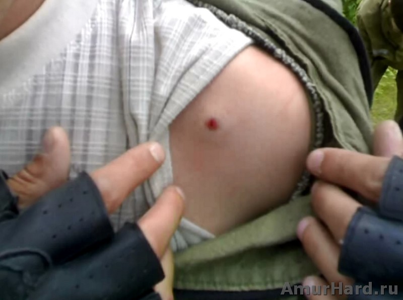 хардбол травмы хардбол травмы